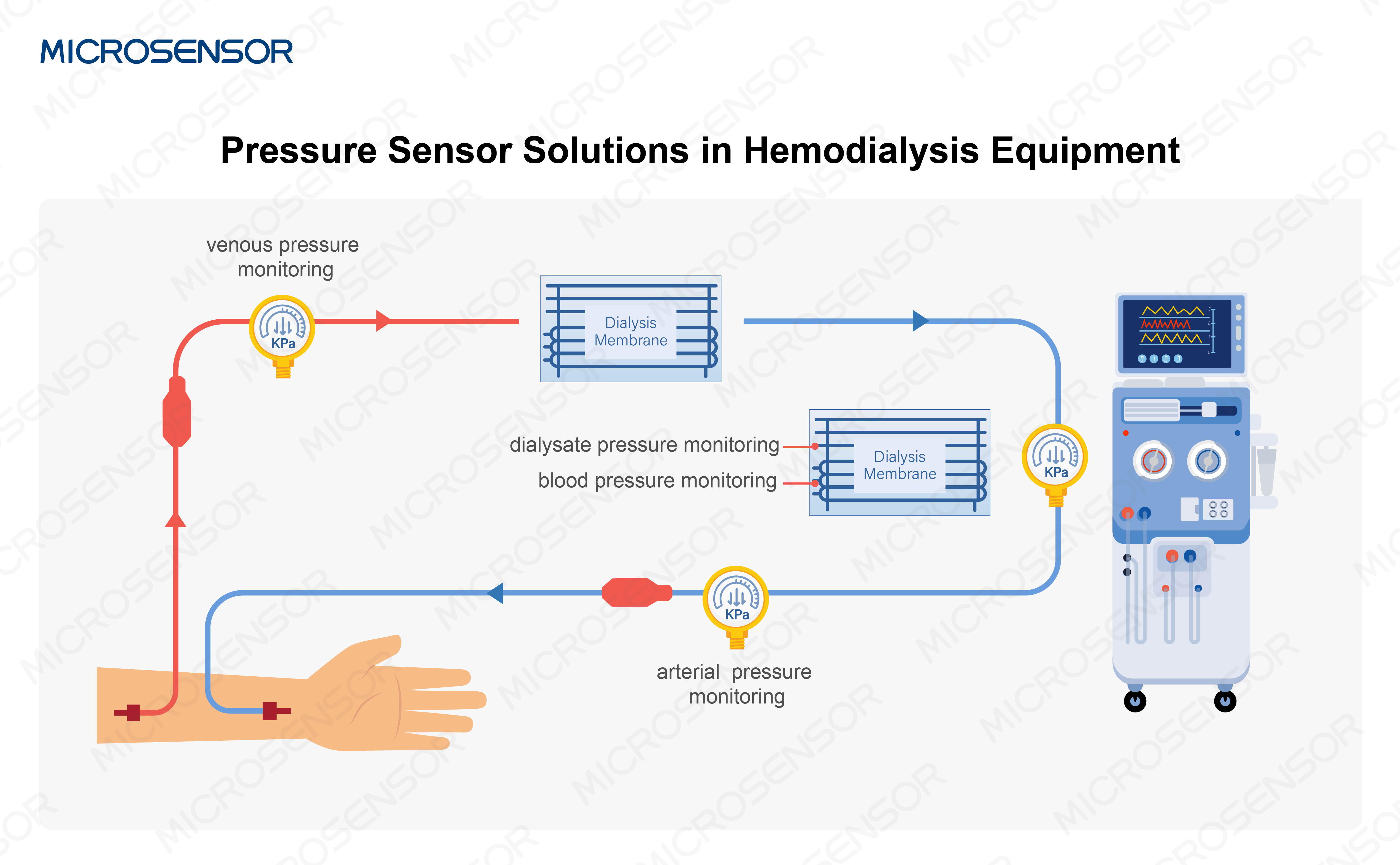 pressure sensor solution in hemodialysis 